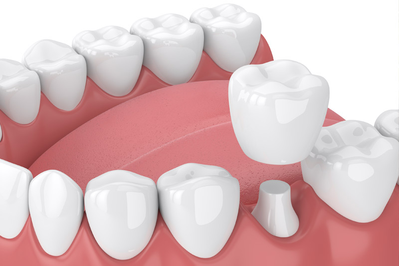 Dental Crowns in Rock Hill