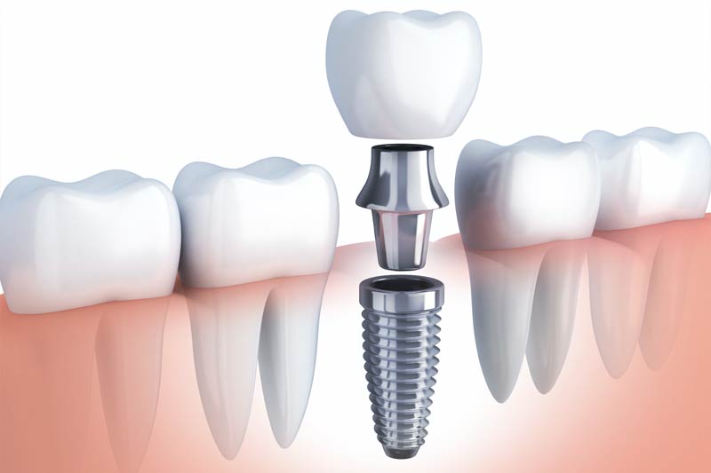 Implants Dentist in Rock Hill