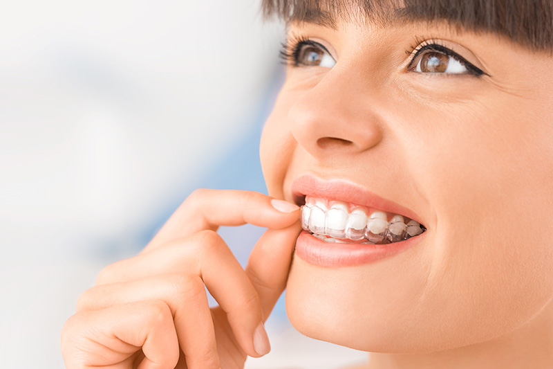 Invisalign in Rock Hill