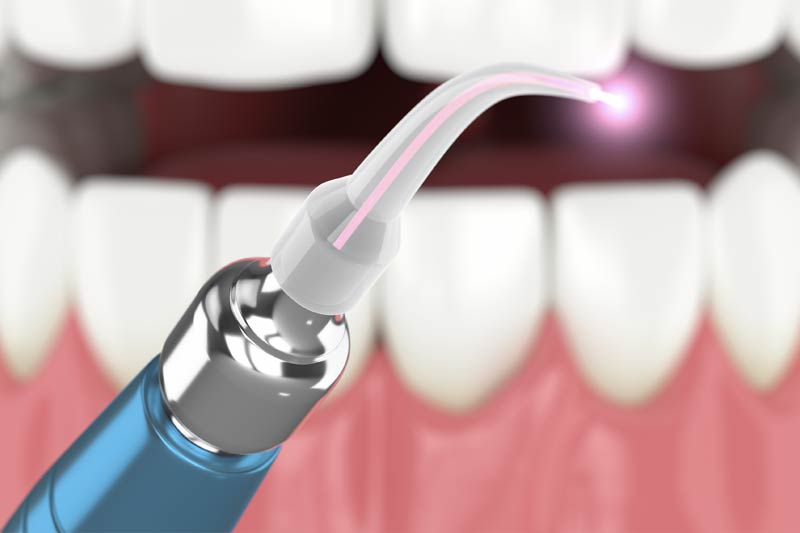 Laser Dentistry in 