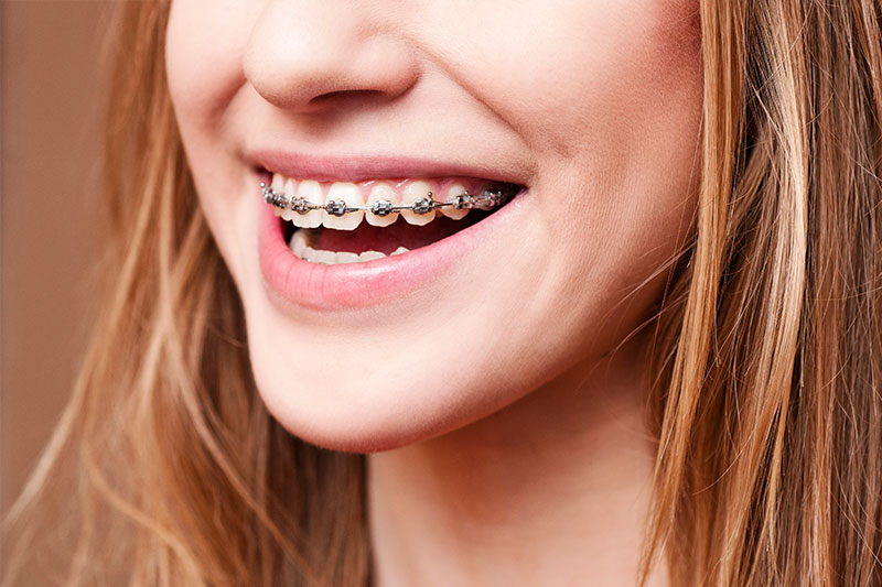 Orthodontics in Rock Hill