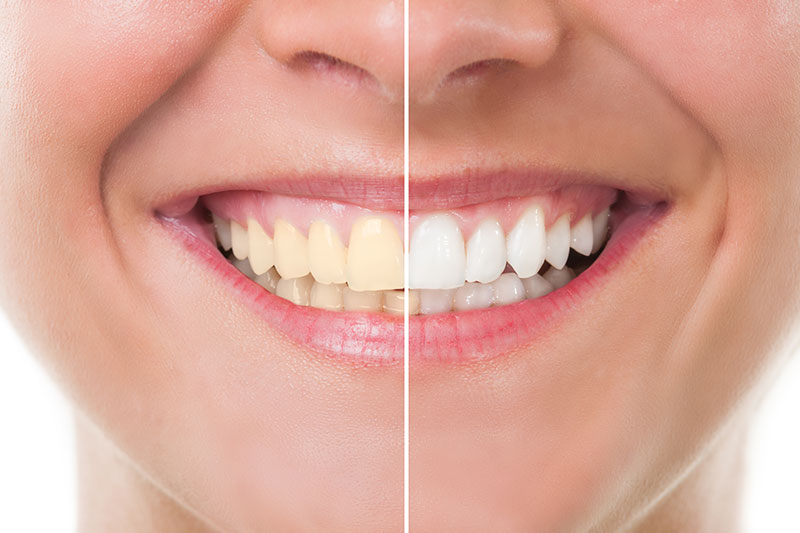 Teeth Whitening in Rock Hill