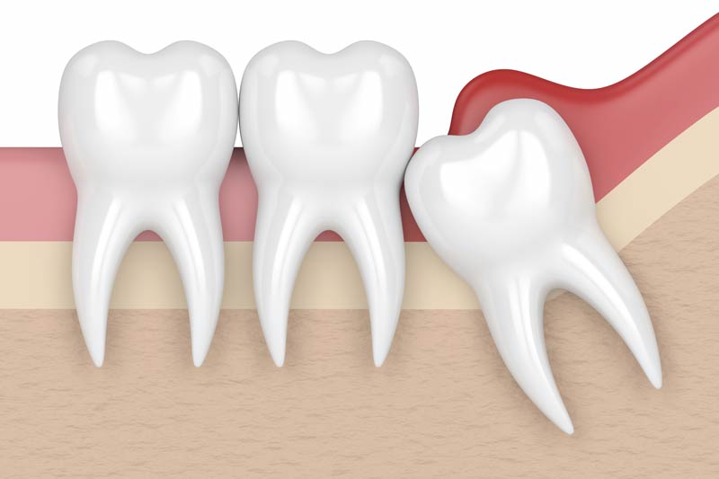 Wisdom Tooth Removal in Rock Hill